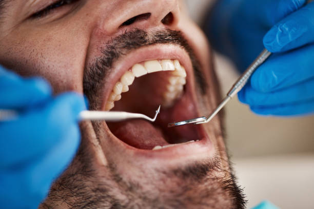 Best Emergency Dental Care for Broken or Chipped Teeth in Sonoma, CA